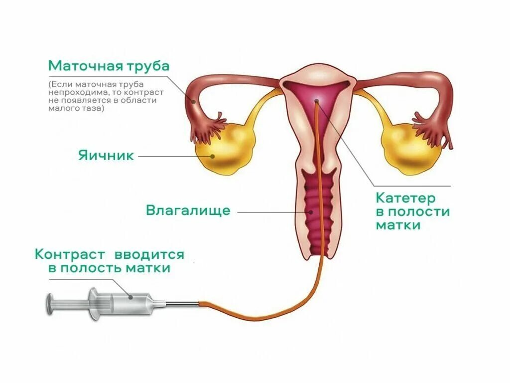Метросальпингография маточных труб. Эхогистеросальпингография (эхо-гсг). Ли узи маточные трубы. Гистеросальпингография однорогая матка. Ультразвуковое исследование маточных труб на проходимость.