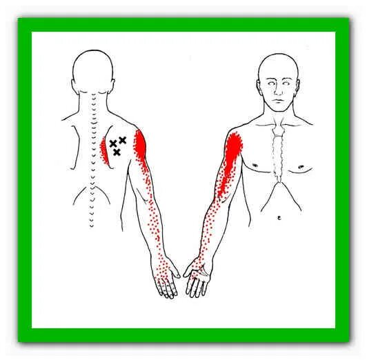 Болезненный узел. Триггерные точки человека. Точки расслабления каналов. Места прощупывания костных точек. Мышечные узлы как выглядят.