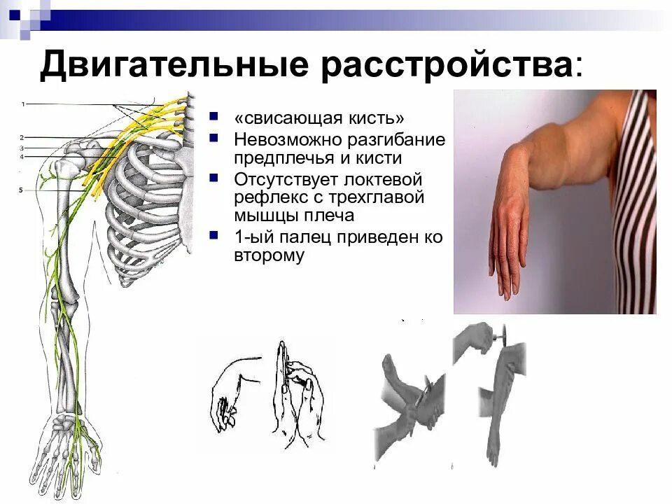 Наружная невропатия. Невропатия локтевого нерва двигательные расстройства. Срединный нерв двигательное расстройство. Невропатия лучевого локтевого и срединного нервов. Невропатия срединного, локтевого, лучевого.