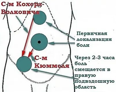 Симптом кохера