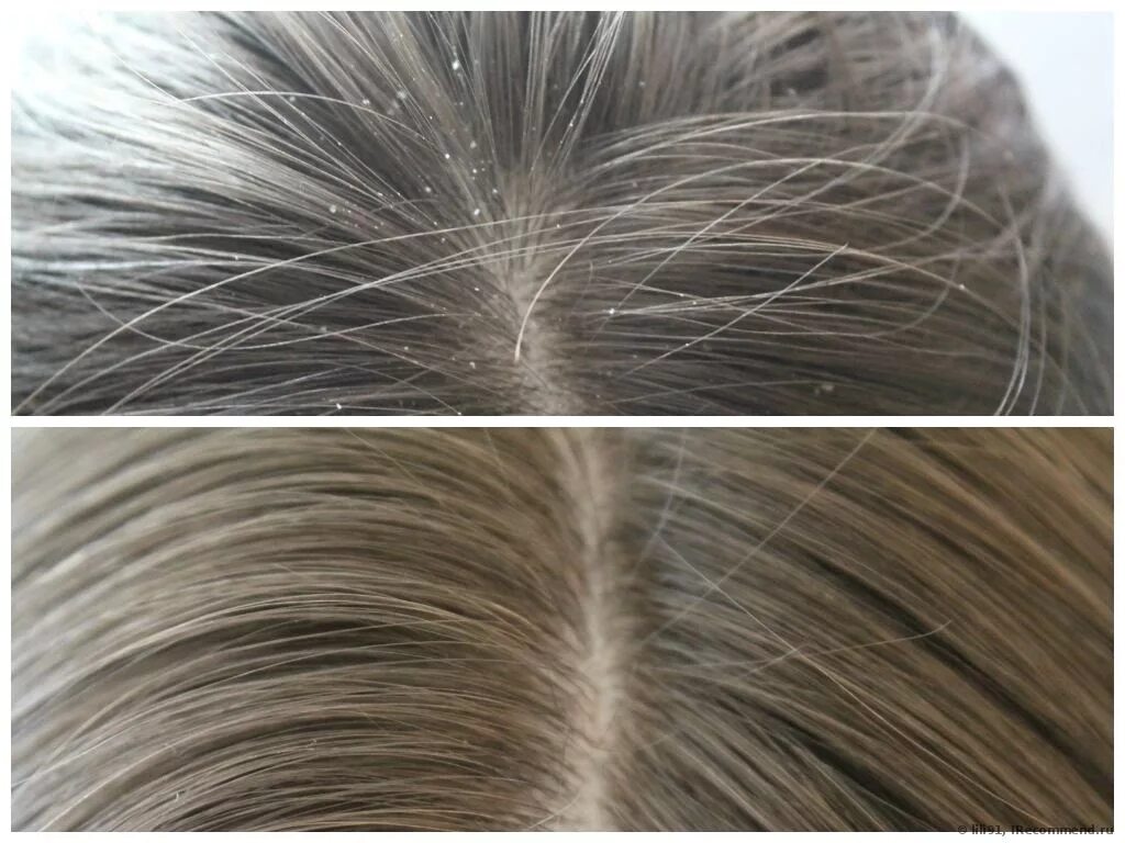 Хэппи хэир. Пилинг головы до после. Асбестовидный себорейный дерматит. Отшелушивание кожи головы. Пилинг для головы.