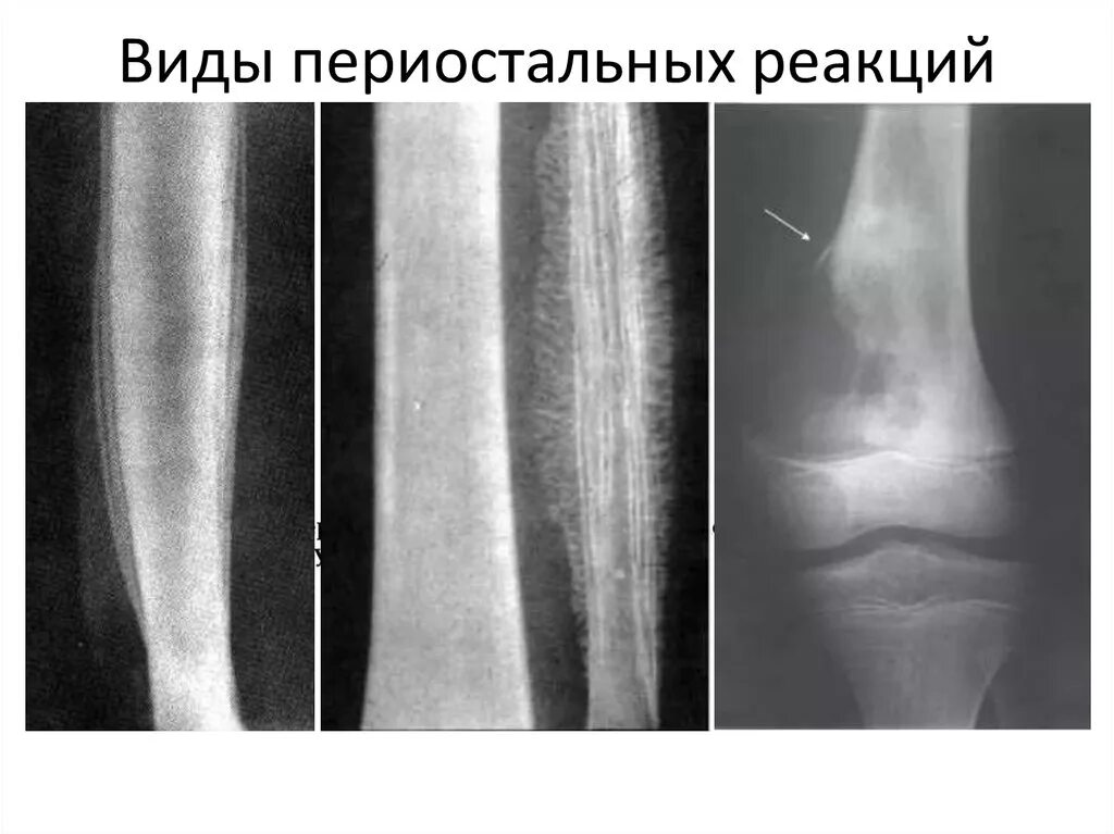 Вторичное поражение костей. Бахромчатый периостит рентген. Остеомиелит большеберцовой кости кт. Остеомиелит периостальная реакция. Линейный периостит большеберцовой кости.