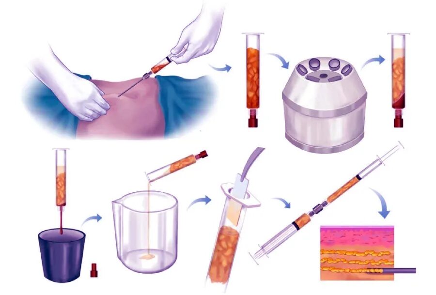 Липофилинг половых губ до и после. Липофилинг больших половых. Липофилинг полового. Липофилинг полового. Липофилинг инструменты.