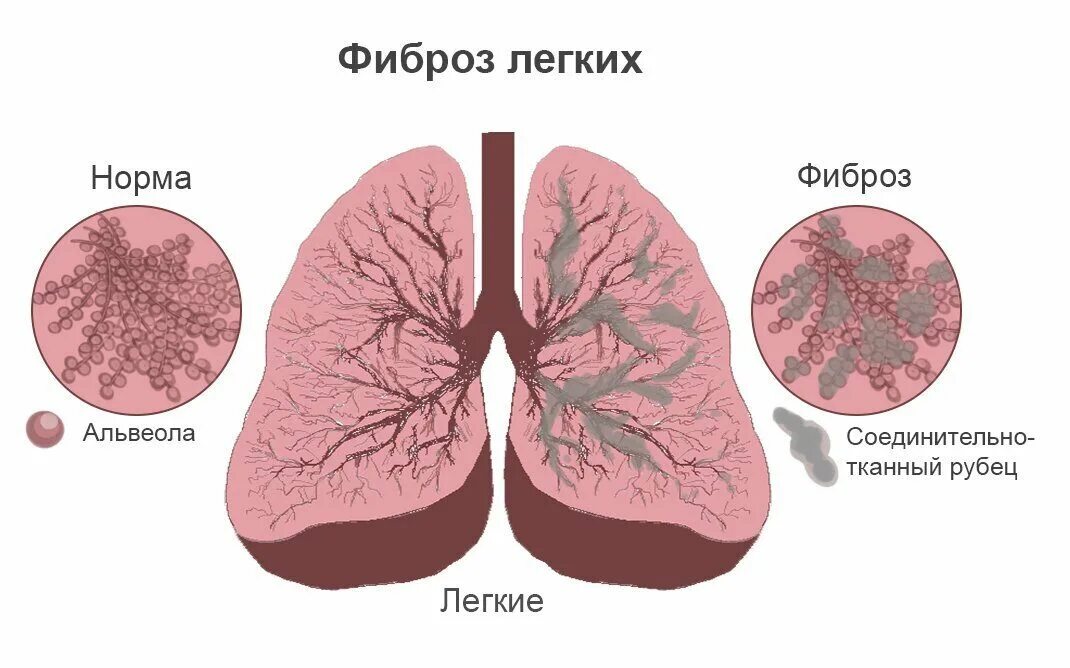 Фиброз после ковида. Тяжистый пневмофиброз легких s5.