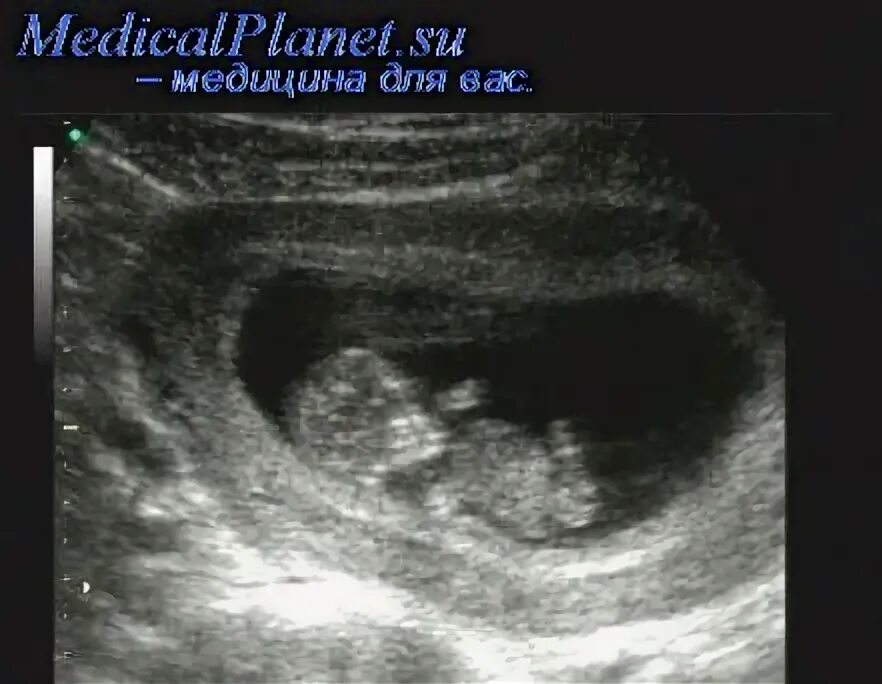 Артерии пуповины узи. Плацента плодные оболочки пуповина. Нормальное строение пуповины. Два сосуда пуповины. Пуповина 1 артерия вена.