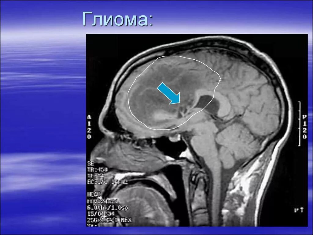 Что такое глиома