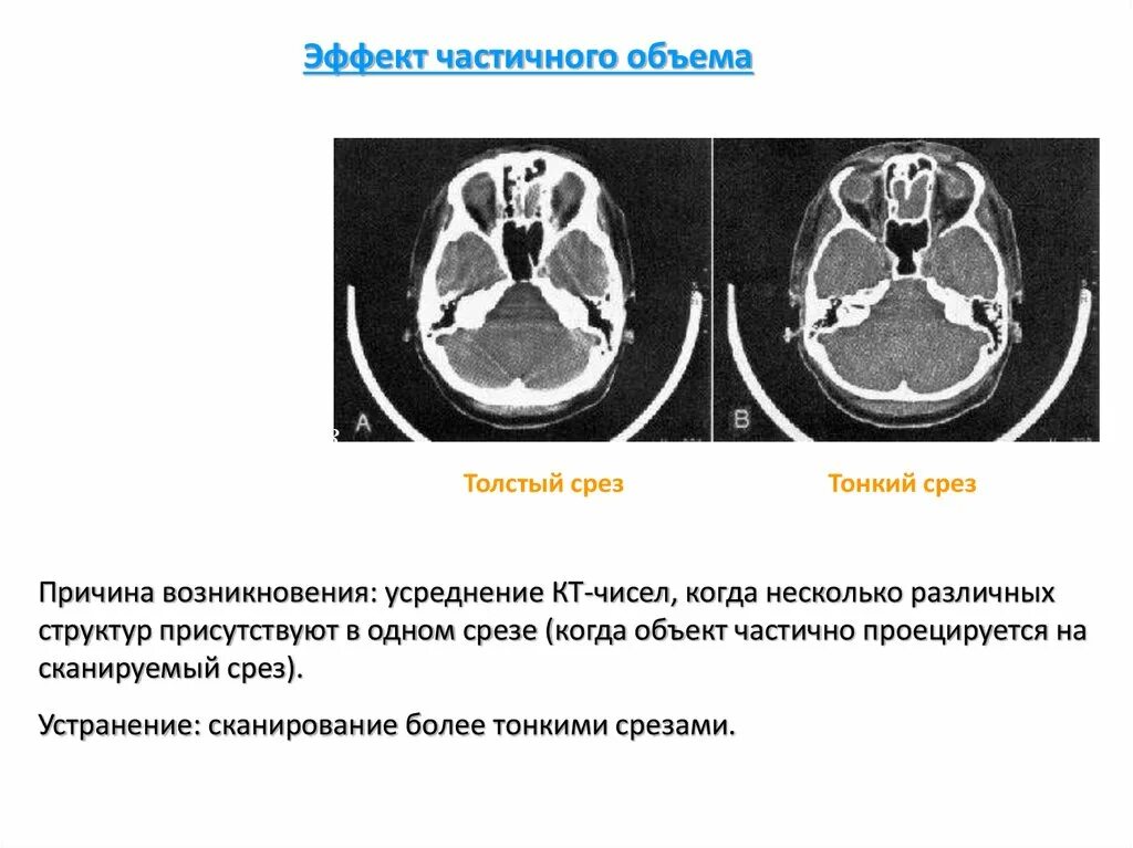 Побочный эффект кт. Тонкие срезы кт. частичный объемный эффект при кт это. кт число. описание одного среза кт.