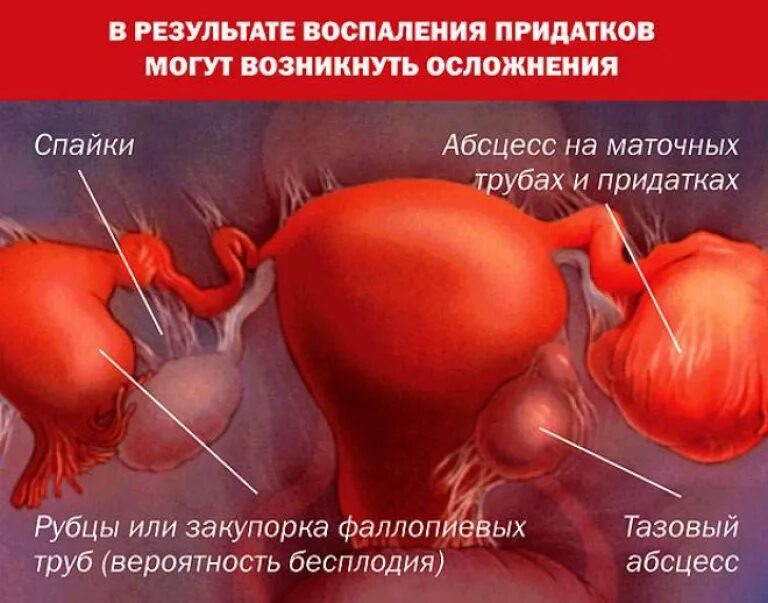 Сальпингоофорит (аднексит). Сальпингит и сальпингоофорит. Аднексид