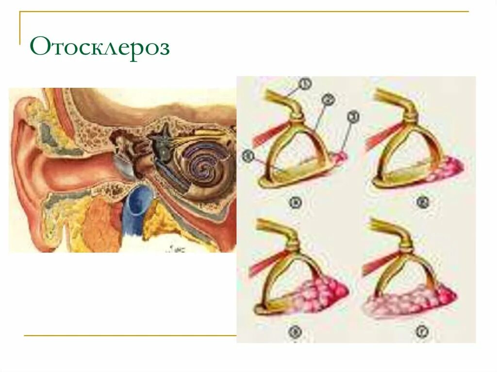 Отосклероз патоморфология. Отосклероз Вовлекающий овальное окно Необлитерирующий. Болезнь ушей отосклероз. Отосклероз уха операция