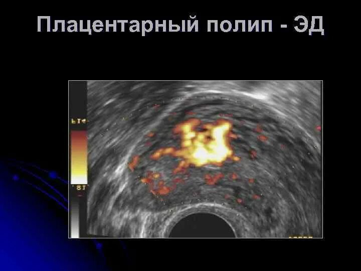 Эндометрический полип. Плацентарный полип на УЗИ.