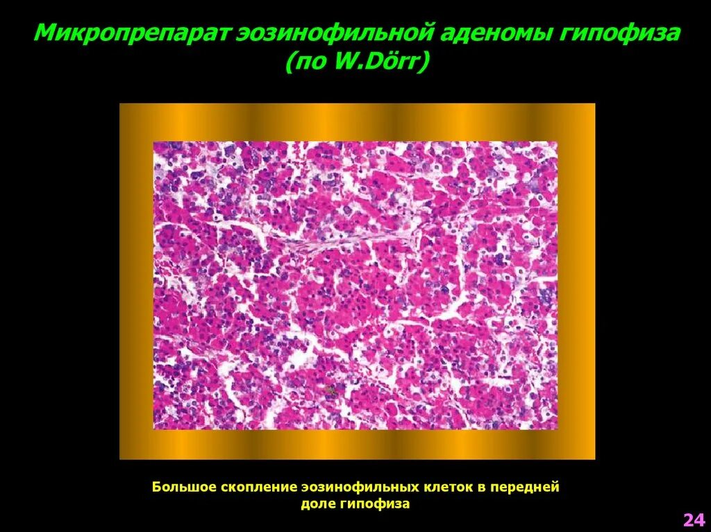 Эозинофильная аденома гипофиза. Базофильная аденома гипофиза гистология. Базофильная аденома. Базофильная аденома гипофиза микропрепарат. Хромофобные клетки гипофиза.
