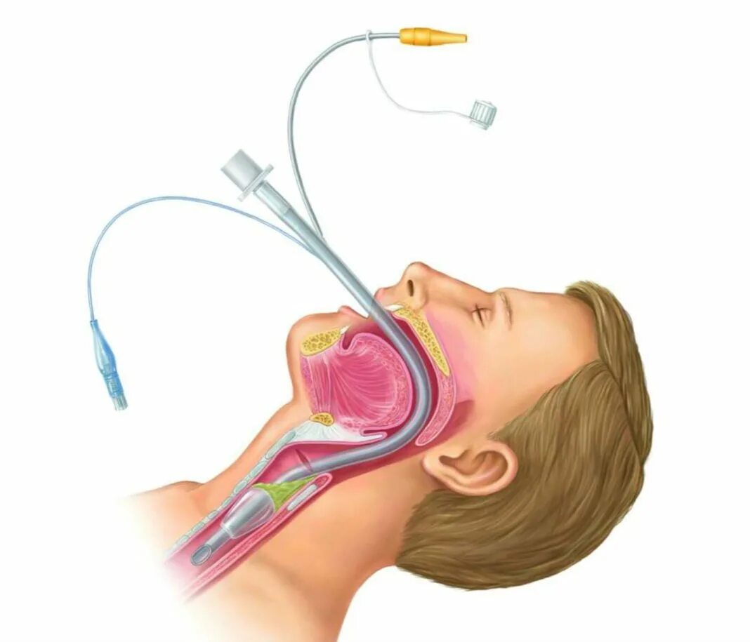 Интубационная трубка ИВЛ. Интубационная анестезия. Интубация эндотрахеальной трубки.
