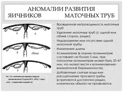 Маточные трубы симптомы