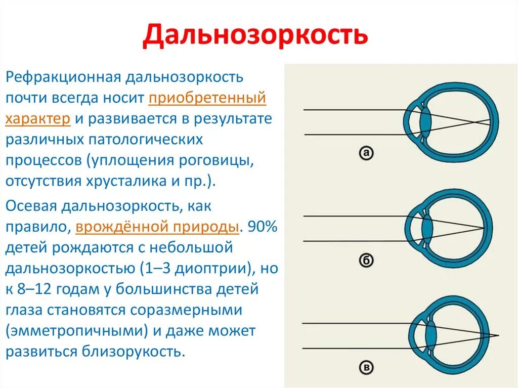 Дальнозоркость что делать. Профилактика близорукости и дальнозоркости. Причины развития гиперметропии. Близорукость и дальнозоркость. Дальнозоркость развивается при.