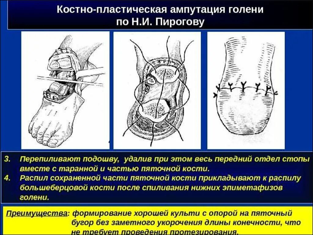 Костно пластическая ампутация стопы по Пирогову этапы. 3 Костно пластическая ампутация голени по Пирогову.. Костно пластическая ампутация Пирогова. Костнопластическая ампутация по Пирогову.