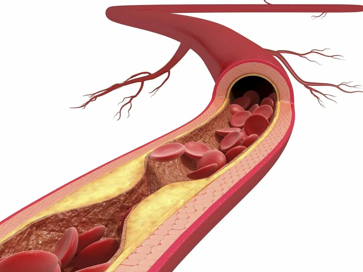 Атеросклероз бляшки сосудов. Атеросклероз (закупорка кровеносных сосудов). Атеросклеротические бляшки в сосудах холестериновые бляшки. Атеросклероз венечных артерий. От бляшек и тромбов как очистить