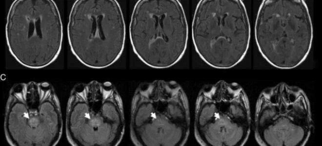 Резидуальное поражение мозга. Резидуальная энцефалопатия мрт. Энцефалопатия Маркиафавы-Биньями. Резидуальная энцефалопатия кт. Рассеянный энцефаломиелит мрт.