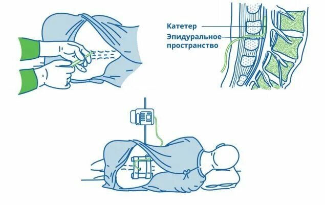 Проведение эпидуральной анестезии. Уровни эпидуральной анестезии схема. эпидуральная анестезия катетер. спинальная и эпидуральная анестезия. номограмма эпидуральная анестезия.