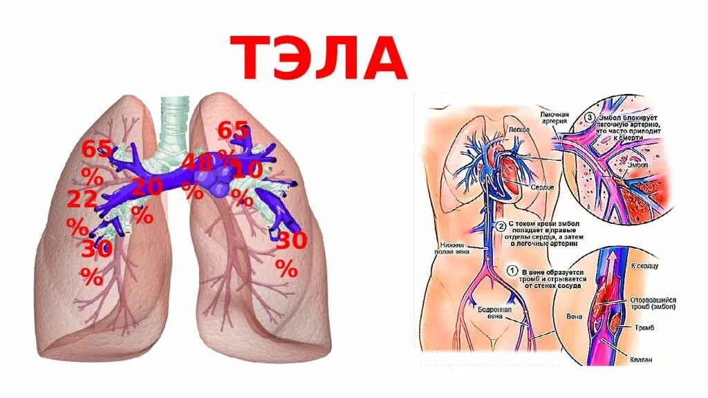 Тромболегочная эмболия. Тромбоэмболия крупных ветвей легочной артерии. Тромбоэмболия ветвей легочной артерии симптомы. Массивная эмболия легочной артерии. Эмболия тромбом легочной артерии (Тэла);.