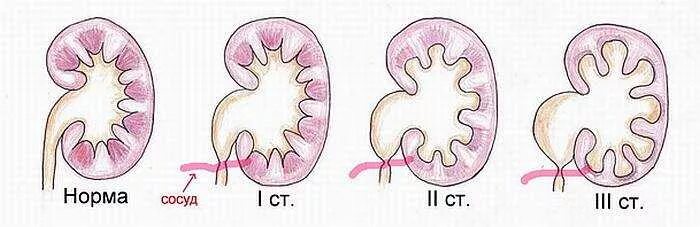 Расширение лоханки гидронефроз. Расширение лоханки почки пиелоэктазия. Стадии гидронефроза почки.