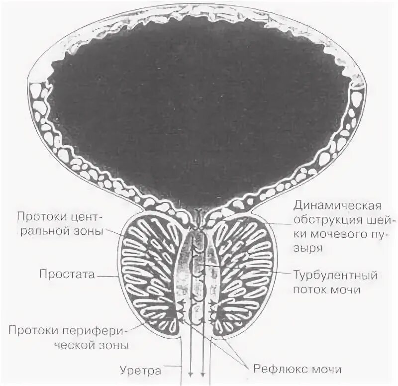 Предстательная железа кальцинаты узи. Микрокальцинаты предстательной железы. Кальцинаты в предстательной железе. Хронический простатит узи. Конкременты предстательной железы.