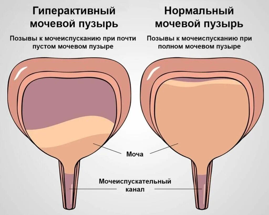 Гипо активный мочевой пузырь. Гиперактивный мочевой пузырь. Гипоактивый мочепвой пузырь. Нейрогенный гиперактивный мочевой пузырь. Уменьшение мочеиспускания