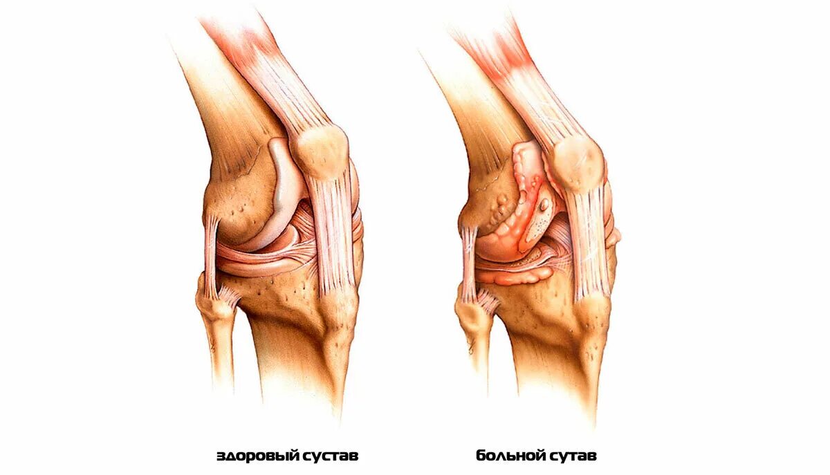 Ревматоидные артрит суставов колени. Ревматоидный артрит локти. Ревматоидный артрит локтевого сустава.