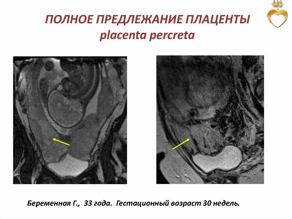 Предлежание плаценты. Полное предлежание плаценты. Предлежание плаценты на УЗИ. Полное предлежание плаценты УЗИ. Плацента на рубце матки