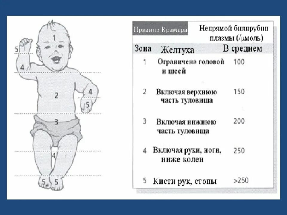 Норма уровня желтушки у новорожденных. Физиологическая желтуха у новорожденных норма. Нормы билирубина у новорожденных при физиологической желтухе. Норма билирубина у новорожденных в 1 месяц при желтушке. Физиологическая желтуха у новорожденных сколько