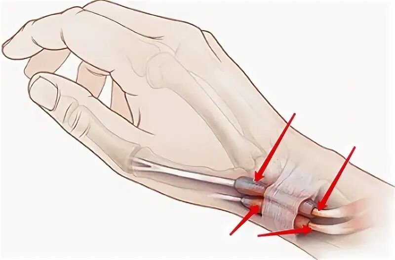 Теносиновит сухожилия кисти. Стенозирующий тендовагинит запястья. Болезнь де Кервена кисти. Крепитирующий тендовагинит предплечья. Тендовагинит де Кервена кисти.