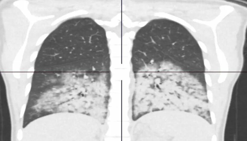 лёгкие курильщика еректродны сигарет. обширное поражение легких. инфекционный бронхиолит кт. лёгкие от электронных сигарет. лёгкие после электронных сигарет.