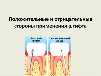 Штифт это