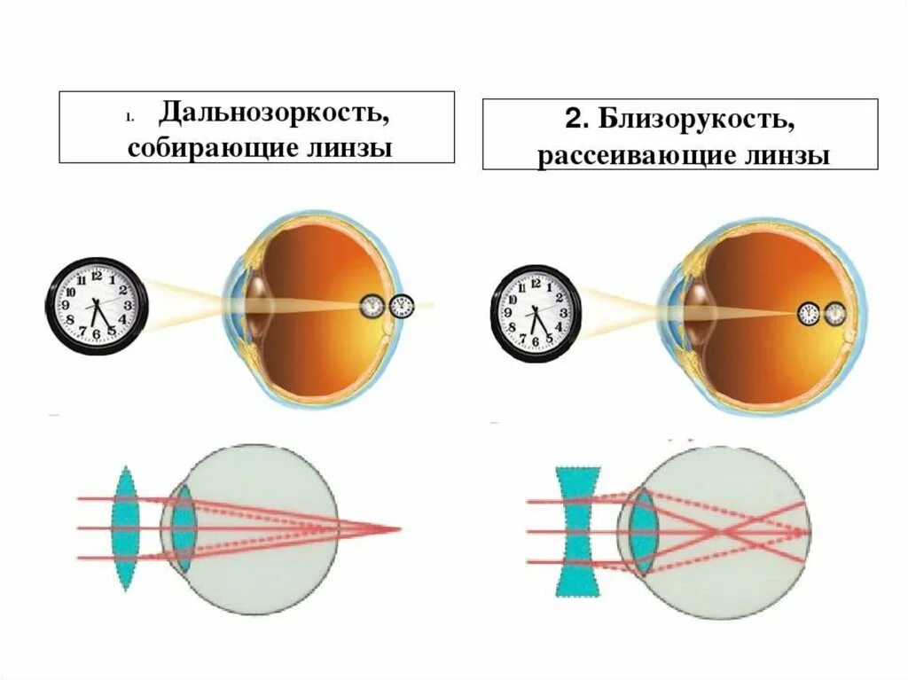 Линзы для глаз для зрения дальнозоркость. Линзы необходимые при близорукости. Коррекция близорукости и дальнозоркости с помощью линз. Контактные линзы дальнозоркости близорукости. Линзы для зрения дальнозоркость