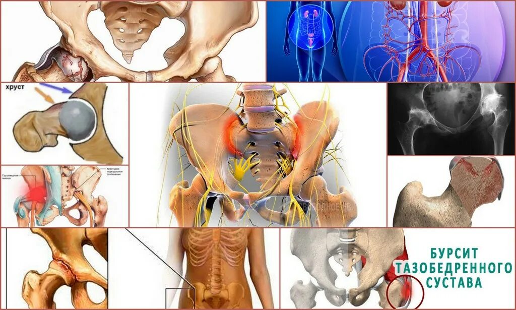 Тазобедренная боль у женщин причины и лечение. Бурсит болезнь тазобедренного сустава. Тазобедренный сустав болит. Щелкает тазобедренный сустав. Щелканье тазобедренного сустава.