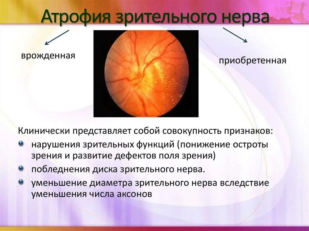 Лечение глазного нерва. Клинические признаки поражения зрительного нерва. Симптомы при атрофии зрительного нерва. Частичная атрофия зрительного нерва врожденная. Нейрооптикопатия зрительного нерва.