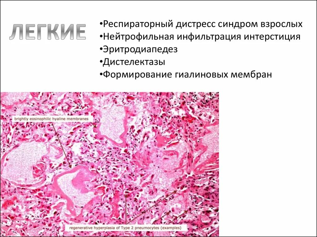 Дистресс синдром взрослых. Респираторный дистресс синдром взрослых патологическая анатомия. Острый респираторный дистресс синдром патанатомия. Гиалиновые мембраны легких микропрепарат. Респираторный дистресс синдром взрослых патанатомия.