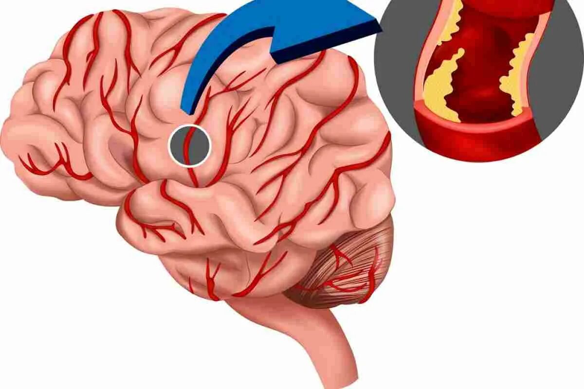 Ишемия ишемический инсульт мозга. Инсульт ишемический (закупорка сосуда). Атеросклероз церебральных артерий симптомы. Ишемический церебральный инсульт.