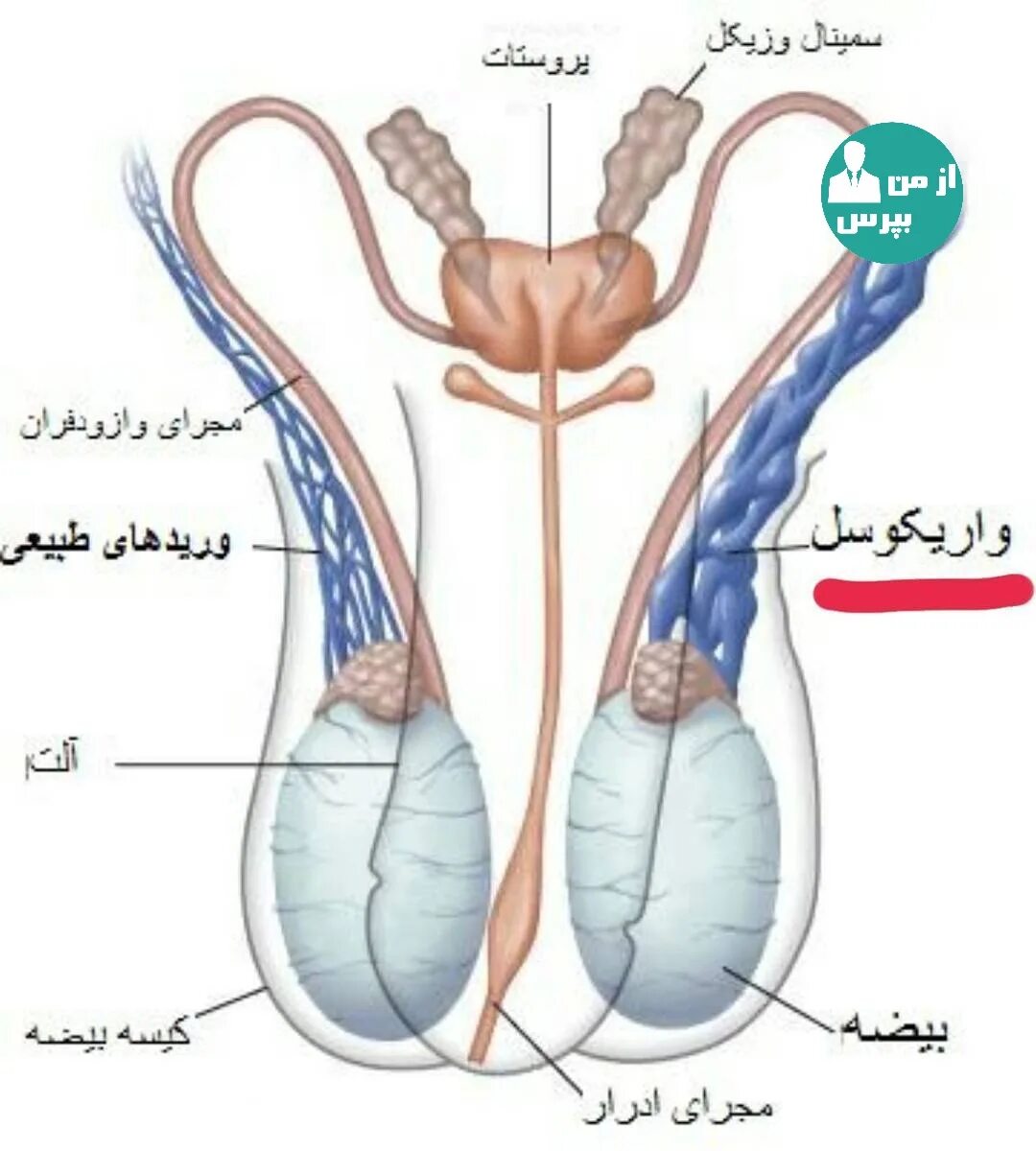 Воспаление семенного канатика у мужчин. Варикоцеле – расширение вен семенного канатика. Утолщение семенного канатика. Расширение семенного канала. Эмболизация варикоцеле.