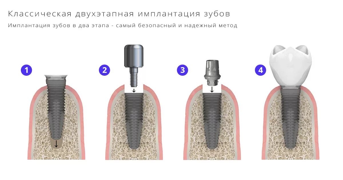 Двухэтапная имплантация зубов классическая имплантация, цена