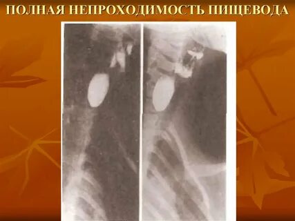 Непроходимость пищевода