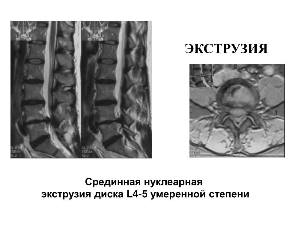 Экструзия дисков шейного отдела позвоночника. Экструзии дисков l3-s1. Центральная экструзия диска l2-l3. Медиальная грыжа экструзия. Экструзии дисков l4-s1.