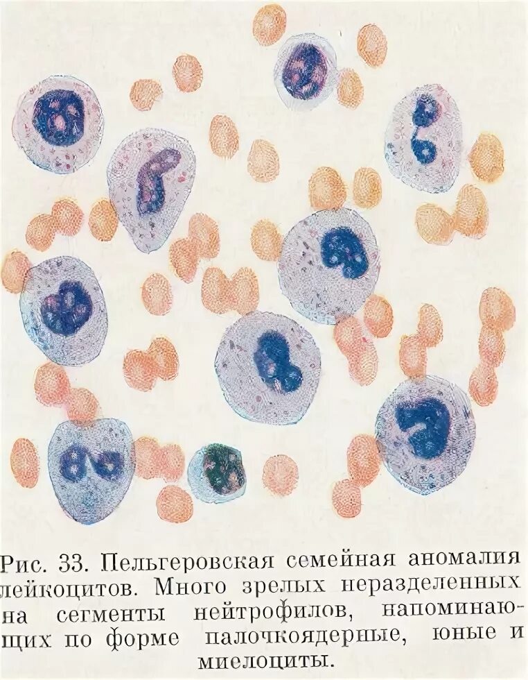 Пельгеровская аномалия нейтрофилов. Аномалия лейкоцитов Пельгера. Пельгеровская семейная аномалия лейкоцитов. Патология лейкоцитов