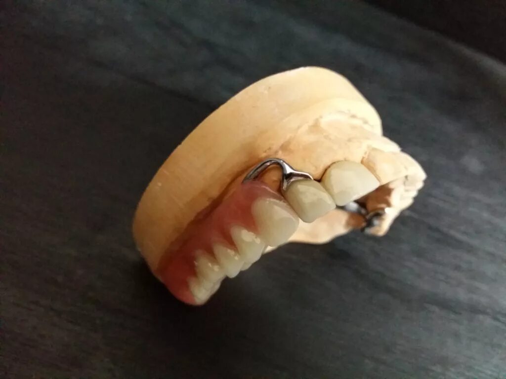 протез на клык