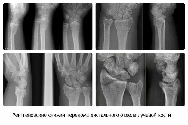 Отзывы после перелома лучевой кости. Оскольчатый перелом лучезапястного сустава. дистальный лучелоктевой сустав рентген. вывих лучевой кости в лучезапястном суставе рентген. костная мозоль на рентгене лучевой кости.