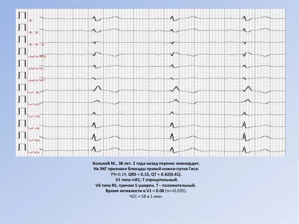 Перенеси назад на 10. ЭКГ при инфекционном миокардите. Миокардит Абрамова-Фидлера ЭКГ. Острый миокардит ЭКГ. Проявления миокардита на ЭКГ.