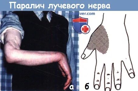Узи лучевого нерва