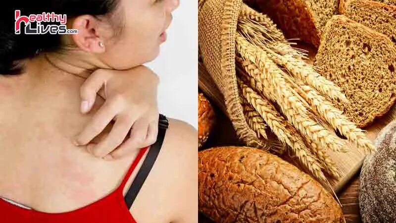 Update on the bird-egg syndrome and genuine poultry meat allergy Allergo Journal