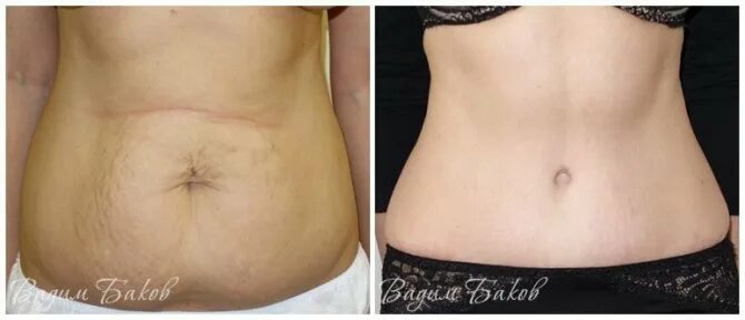 New plastic surgery technique makes belly fat look like chiseled abs