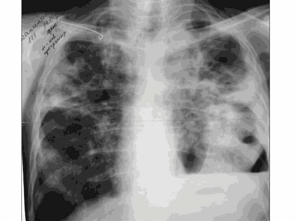 Туберкулез каверны рентгенограмма. Фиброзно-кавернозный туберкулез рентген. Инфильтративный туберкулез рентген. Цирротический туберкулез рентген. Диффузно инфильтративная
