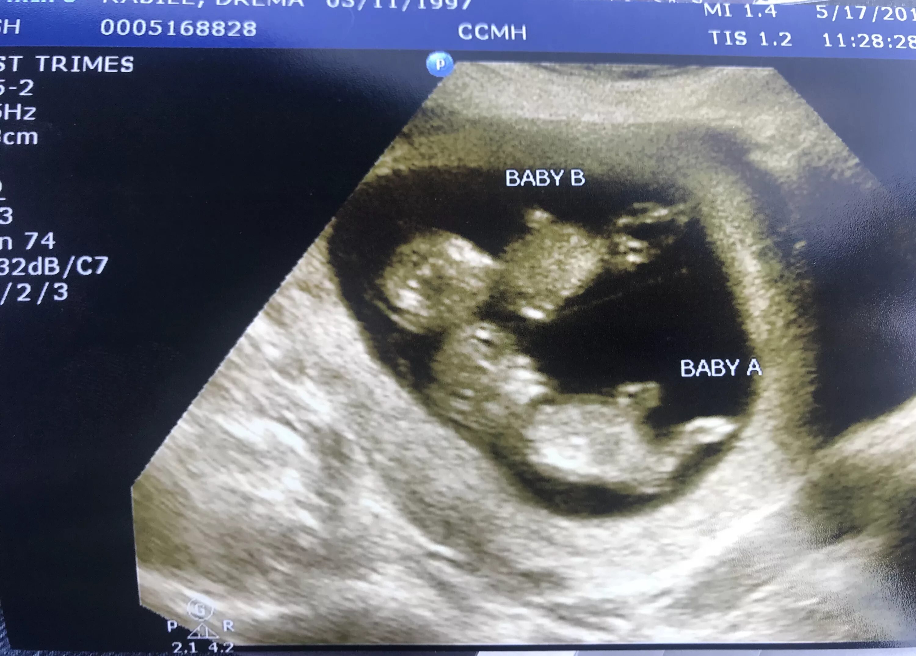 Клостилбегит при планировании беременности двойней. Клостилбегит 50мг n10 таб. Двойня после клостилбегита. Овуляция после стимуляции клостилбегитом. Двойня после клостилбегита.